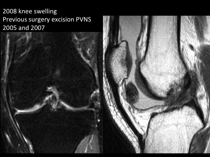 Figure 2 for case pigmented villonodular synovitis ( RID3641 )